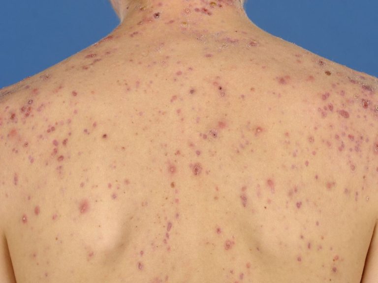 acne voorbeeld